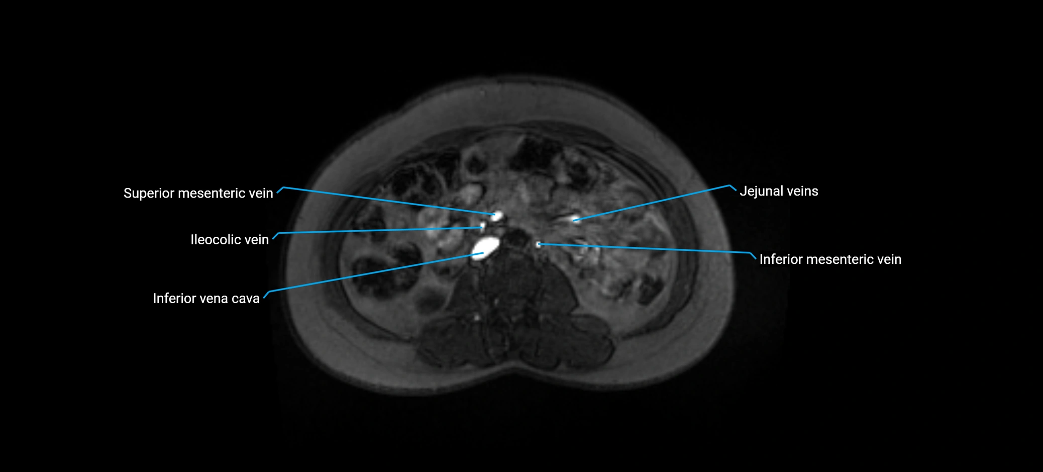 MRV abdomen pelvis & lower limb axial cross sectional anatomy labelled MRI image 87 (1).webp